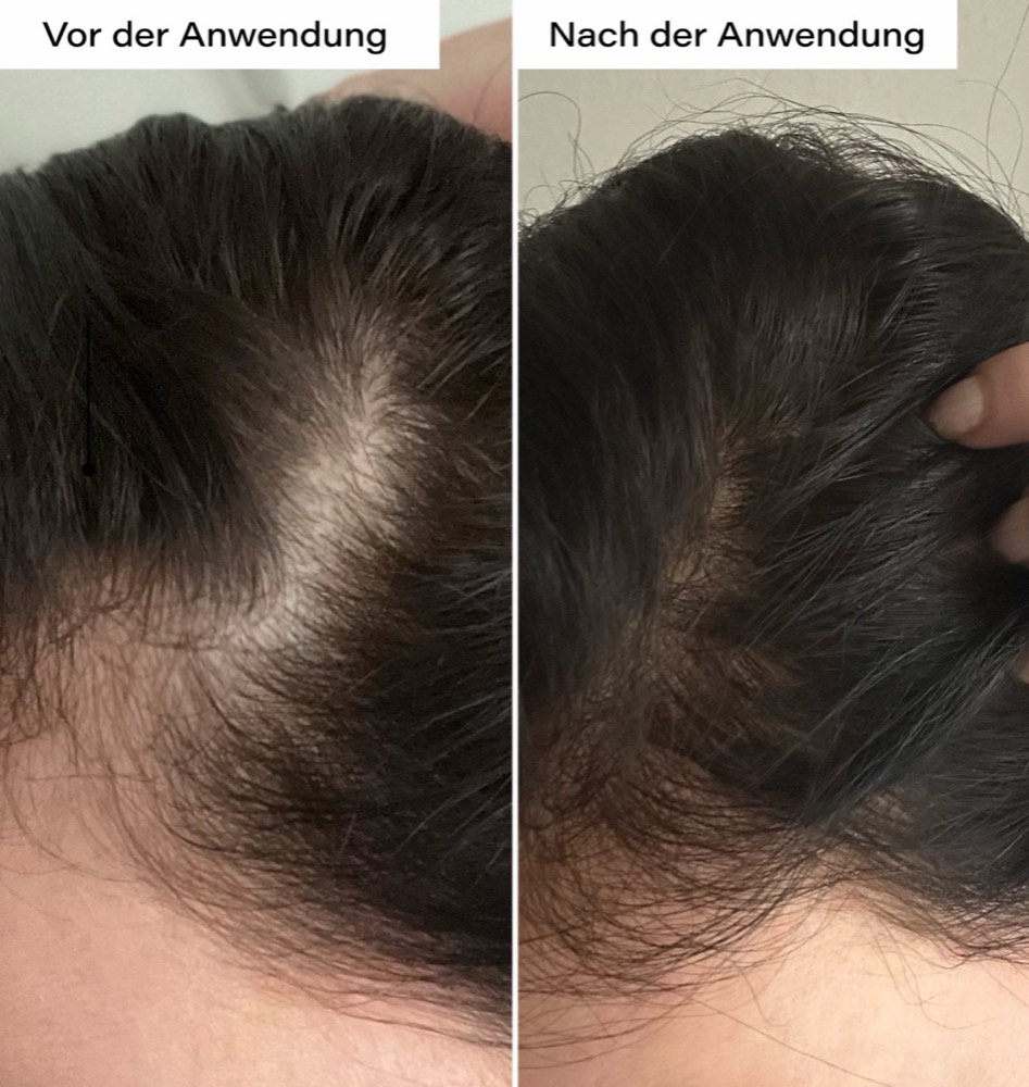 Hair Growth Boost Duo – 5
