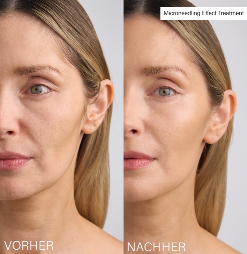 Microneedling Lifting Effect Duo – 3