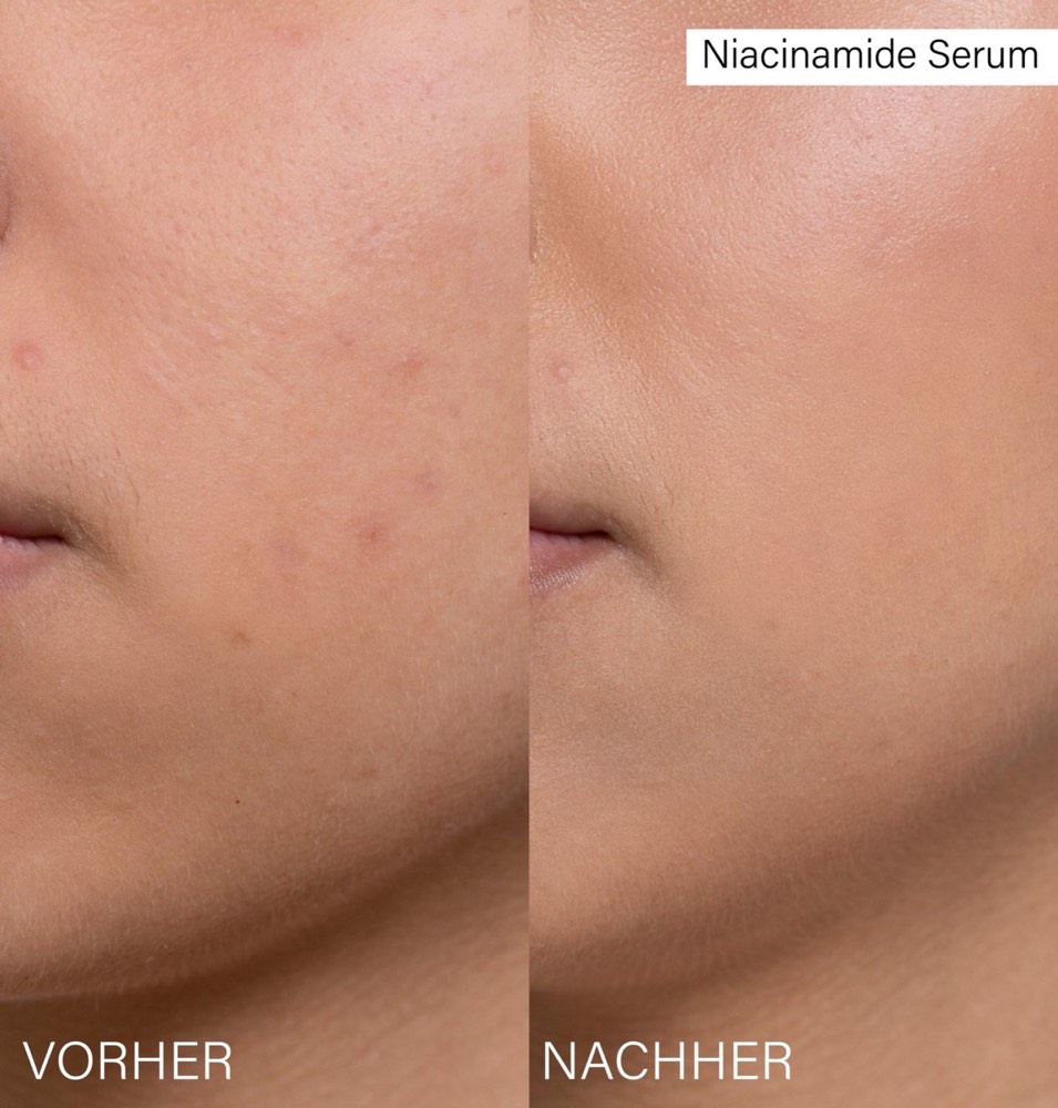 Pore Refining Set – 3