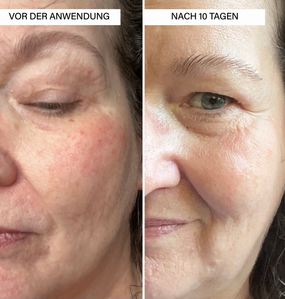 Anti-Hyperpigmentation Set – 4