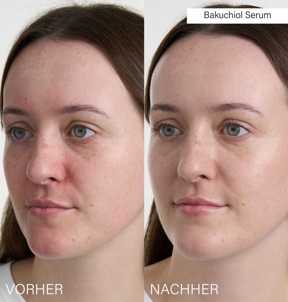 Pore Refining Set – 4