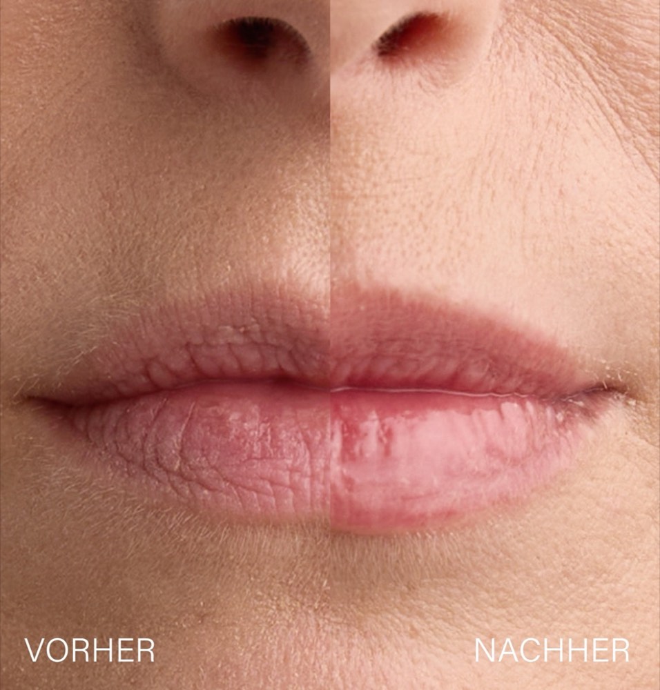 Lip Plumper – 3
